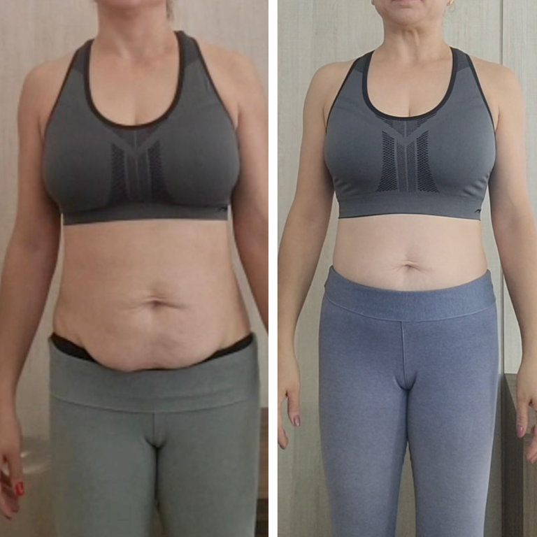 Antes e Depois da Diástase Abdominal pós-parto