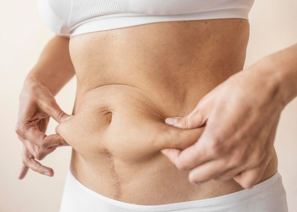 diástase abdominal 