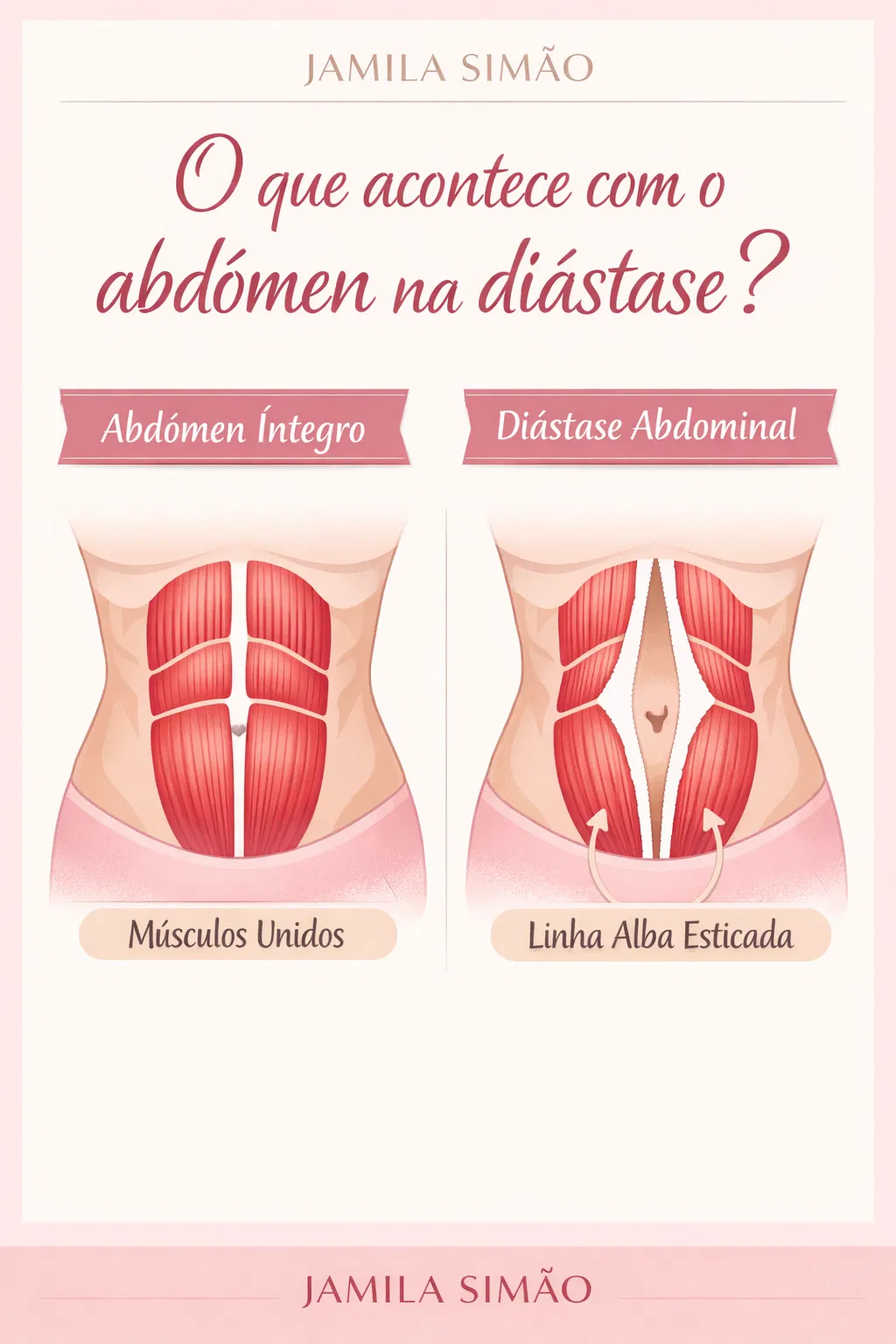 Ilustração anatômica da diástase abdominal mostrando a separação dos músculos retos.