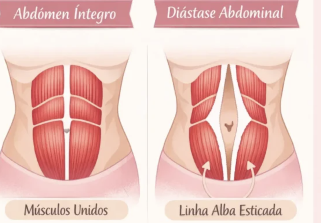diástase e maternidade